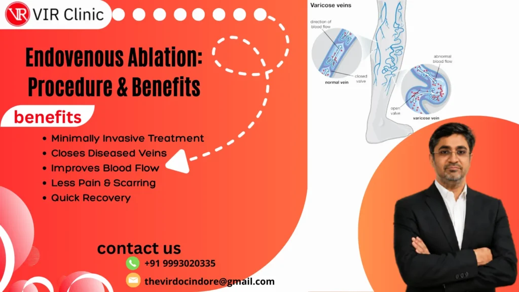 Endovenous Ablation for Varicose Veins: Procedure Explained
